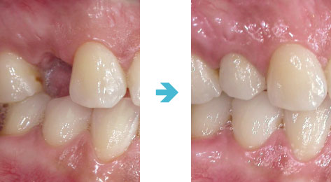 インプラント症例1